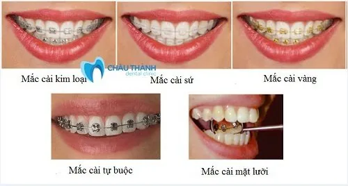 Các loại mắc cài tại nha khoa Châu Thành Niềng răng mắc cài 1