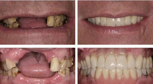 Kết quả khách hàng sử dụng hàm giả tháo lắp