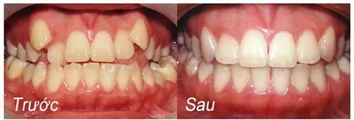 Kết quả niềng răng kết hợp tẩy trắng răng tại Châu Thành Niềng răng mắc cài 4