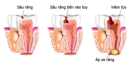 Các trường hợp cần triệt tủy răng