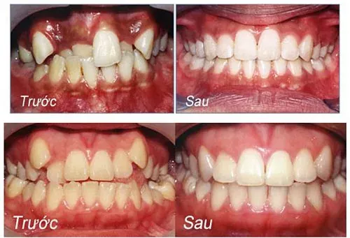 Kết quả niềng răng kết hợp tẩy trắng răng tại Châu Thành Niềng răng mắc cài 3