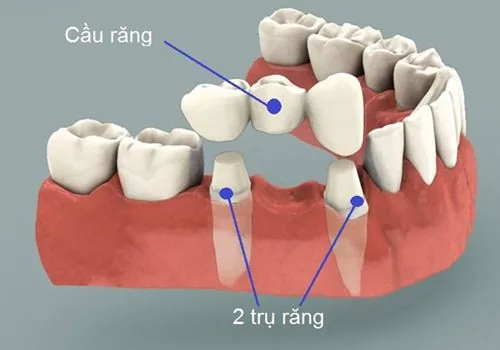 Cầu răng sứ  1