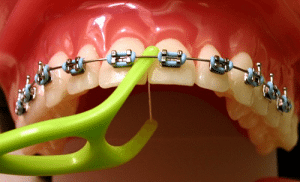 Cấy ghép răng implant giá bao nhiêu