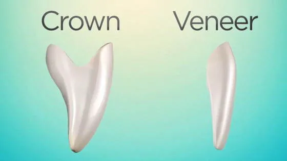 Bọc răng sứ thẩm mỹ 2