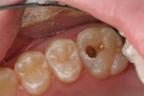Tình trạng sâu răng hàm xảy ra phổ biến ở người lớn tuổi