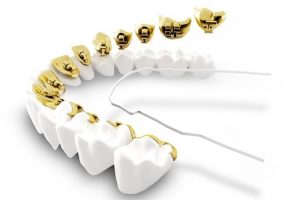 Cấy ghép răng implant giá bao nhiêu