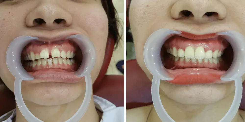 Hình ảnh khách hàng bọc 4 răng cửa khắc phục răng hô, chìa, thưa kẽ