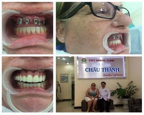 Làm răng implant ở đâu tốt nhất - Nha Khoa Châu Thành