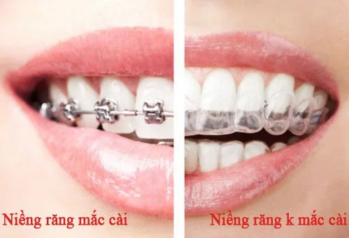 Niềng răng là gì 2