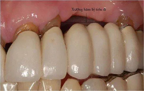 Tình trạng tiêu xương hàm khi mang hàm tháo lắp hoặc làm cầu răng sứ