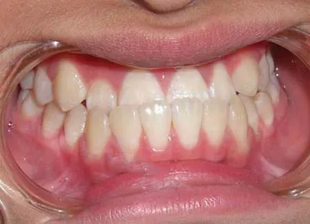 Tình trạng sai khớp cắn phổ biến ở giới trẻ
