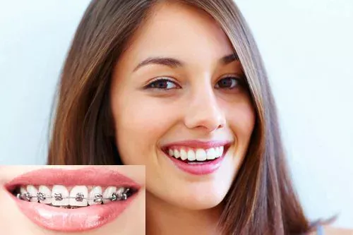 Sau 1 thời gian mang niềng răng sẽ được đưa về đúng vị trí