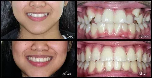 Hình ảnh khách hàng thực hiện niềng răng thành công Quy trình niềng răng 4
