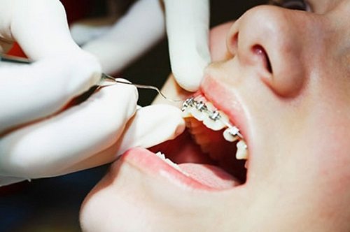 Quy trình niềng răng 3