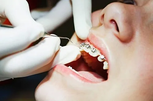 Bác sỹ tỉ mỉ gắn từng mắc cài cho khách hàng Quy trình niềng răng 3