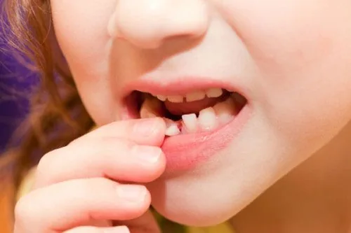 Răng sữa lung lay có nên nhổ không?