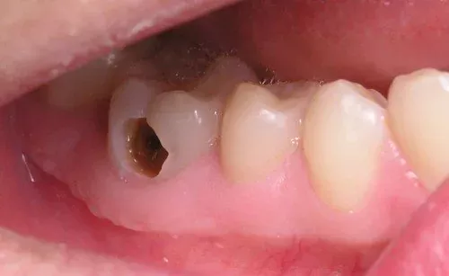 Sâu răng nghiêm trọng có thể gây nhiễm trùng tủy