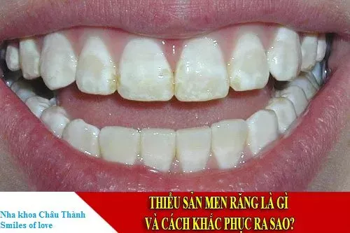 thiểu sản men răng 1