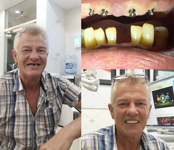 Địa chỉ phòng khám cấy ghép răng implant tại hà nội - Nha Khoa Châu Thành